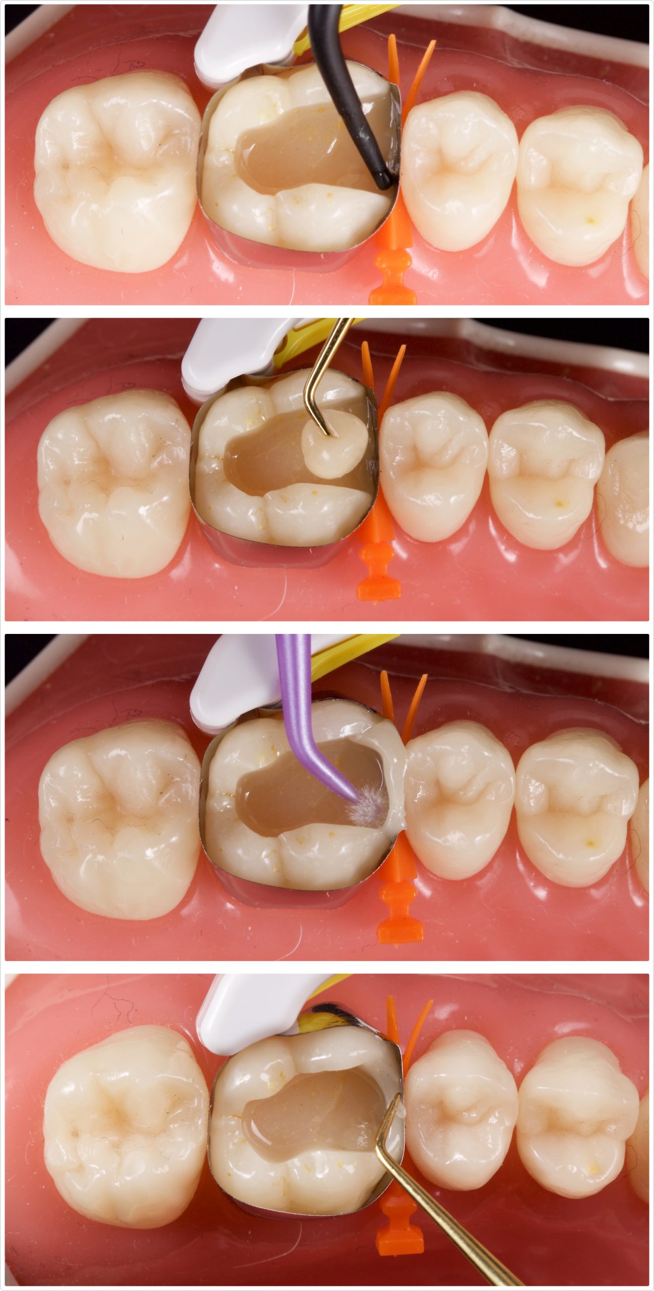 Reducing Sensitivity in Class II Direct Resin Restorations Jason Smithson Class 2 Sensitivity Fig 6 scaled