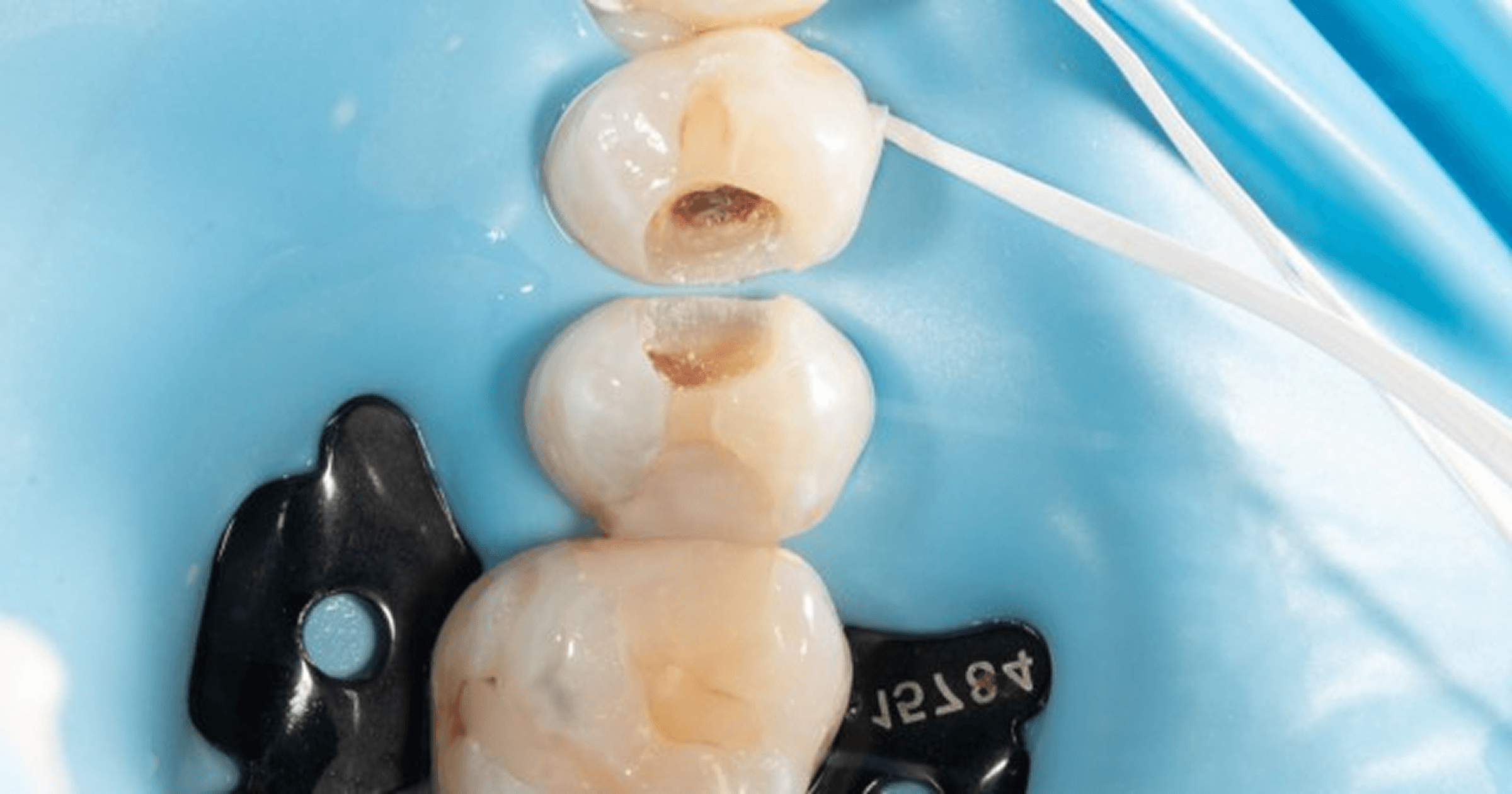 Minimally Invasive Caries Removal: An Evidence-Based Technique Minimally Invasive Caries Removal An Evidence Based Technique
