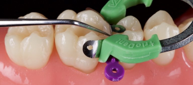 Closing the Class II Restoration Box, Part 3: Restoring the Proximal Box