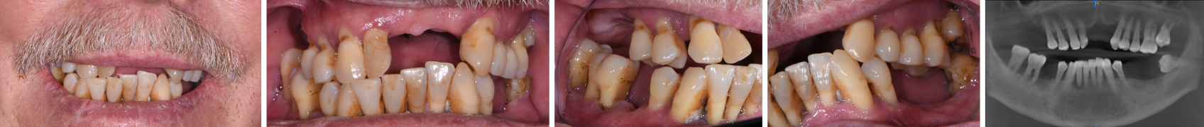 10112 Digest Digital Dentures Figs1 5