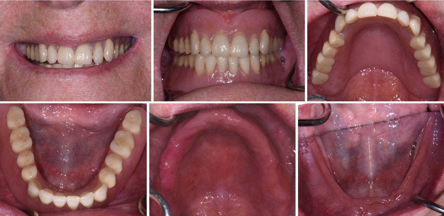 10112 Digest Digital Dentures Figs15 20