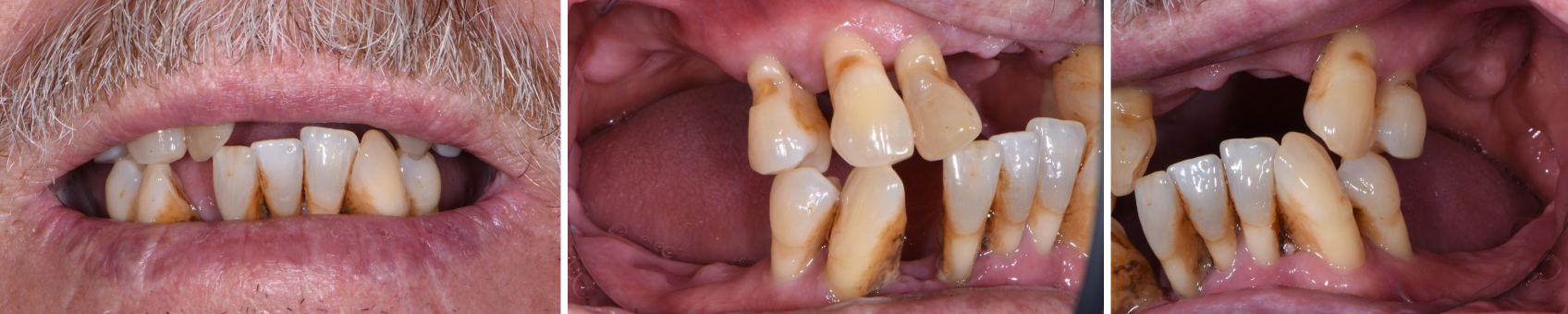 10112 Digest Digital Dentures Figs6 8