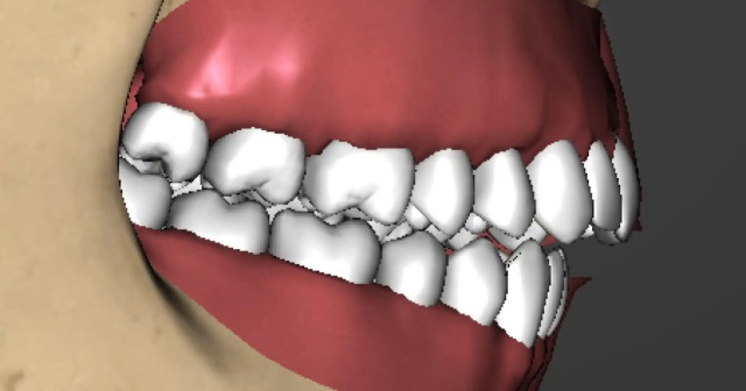 Treating TMD Similarities Between Spears Occlusal Exam and the DC TMD