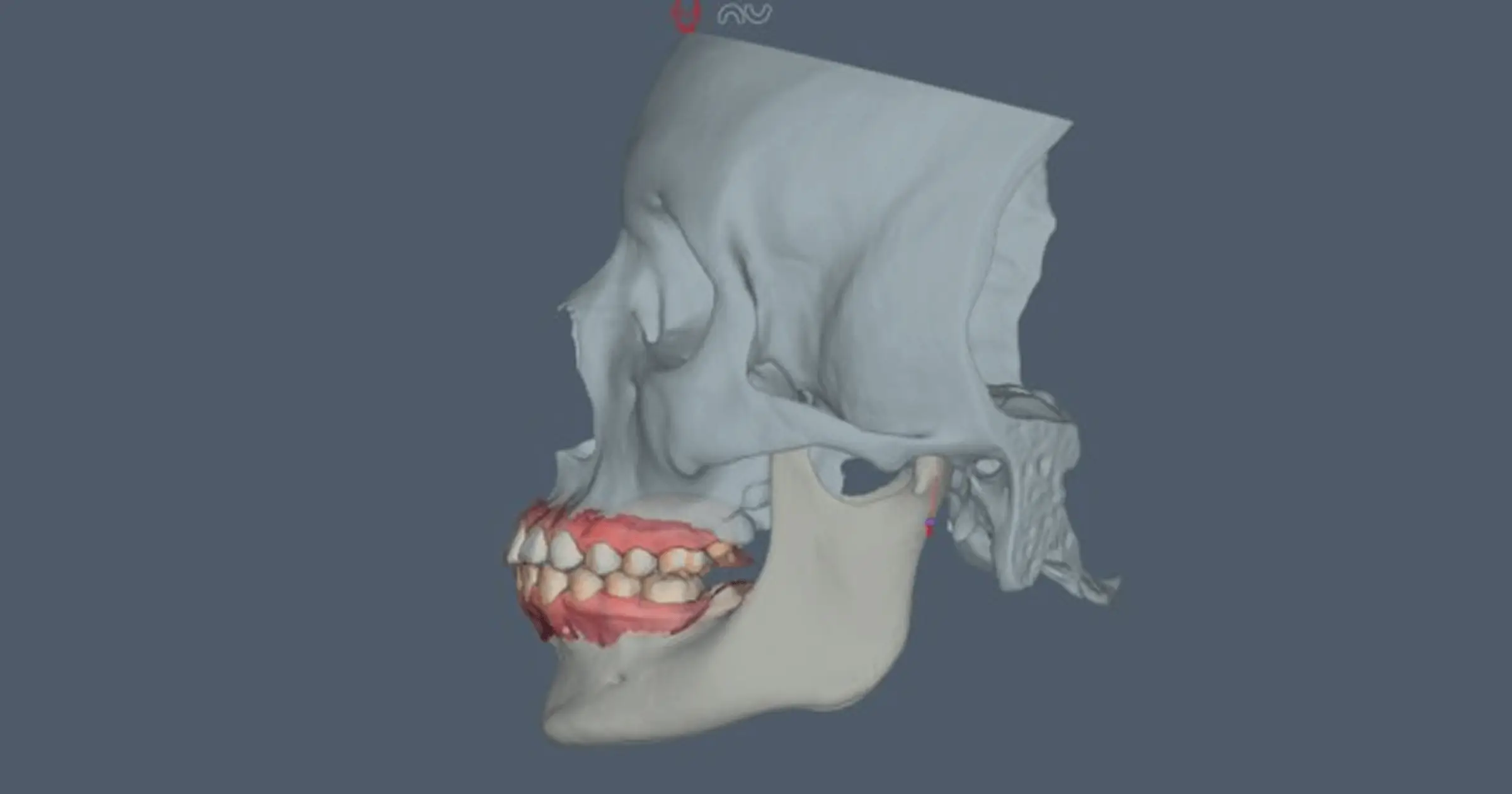 Mandibular Slides