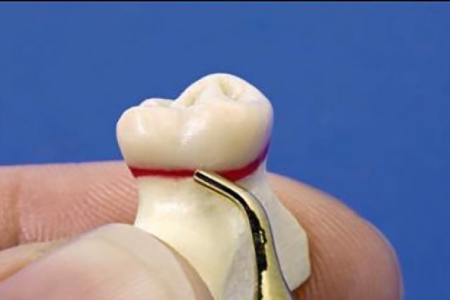 Milled vs. Waxed-And-Pressed Restorations: Which Is Better? 39012