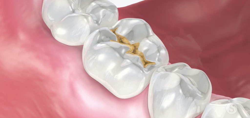 92450 Digest Xylitol Fig 1