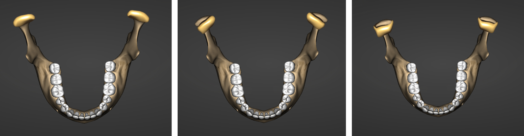 9968 Digest Occlusion Exam Fig 2