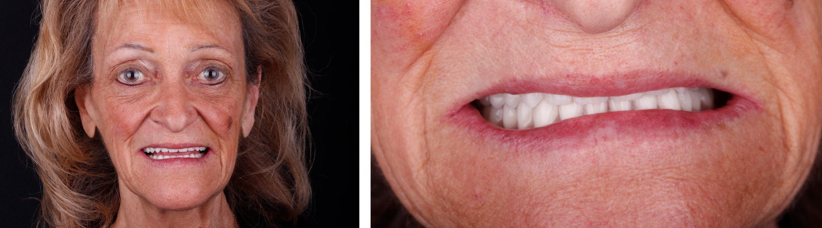 9971 Digest Reference Denture Fig 1 2 1