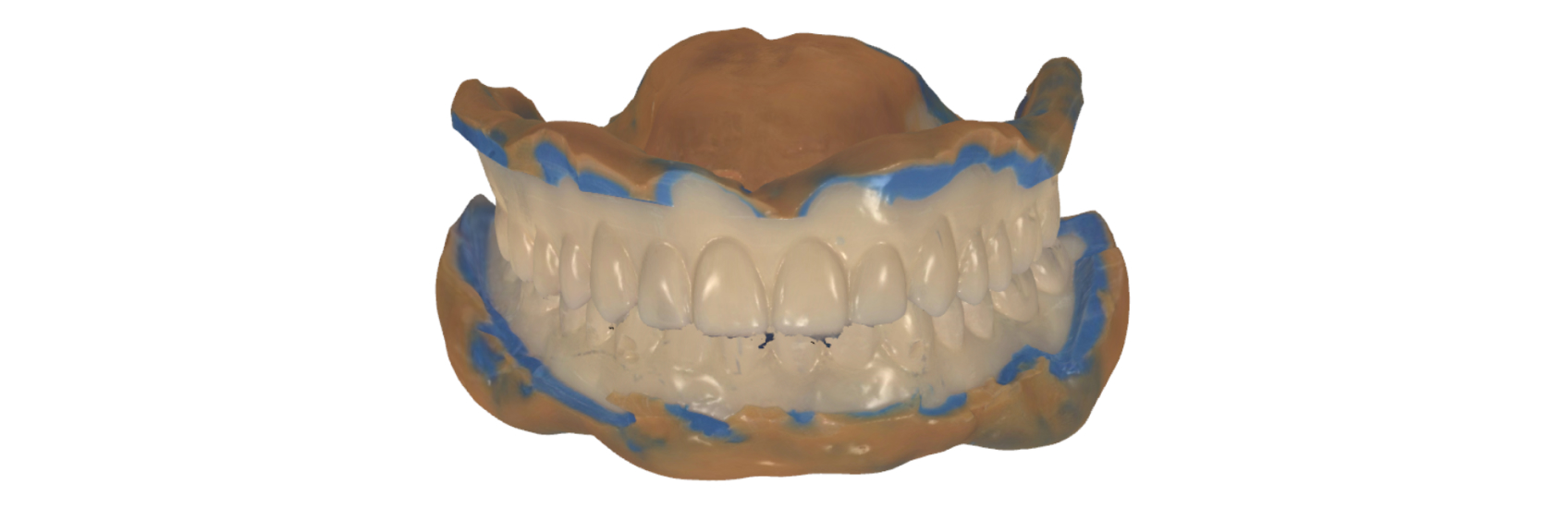 9971 Digest Reference Denture Fig 10