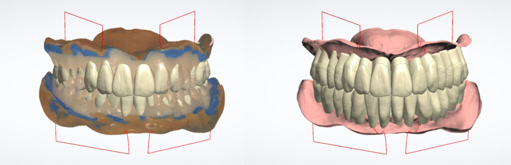 The Reference Denture Technique: An Interdisciplinary Case Study ...