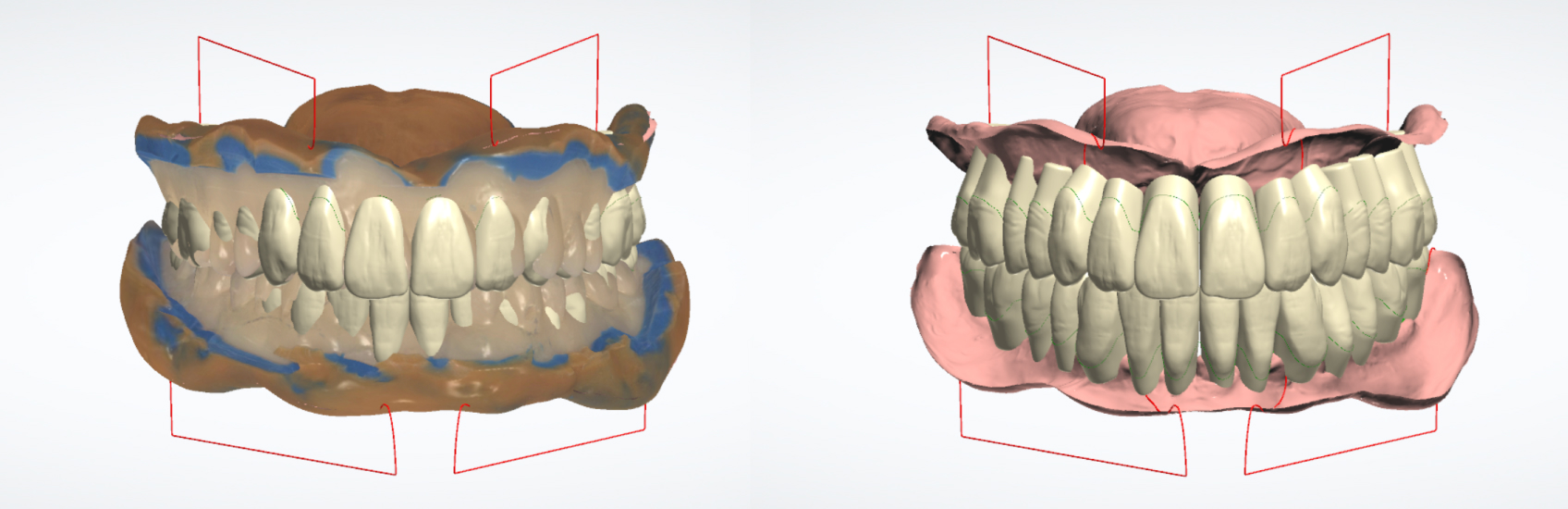 9971 Digest Reference Denture Fig 11 12