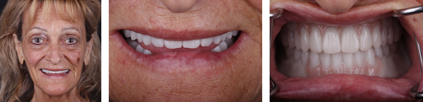 9971 Digest Reference Denture Fig 15 17