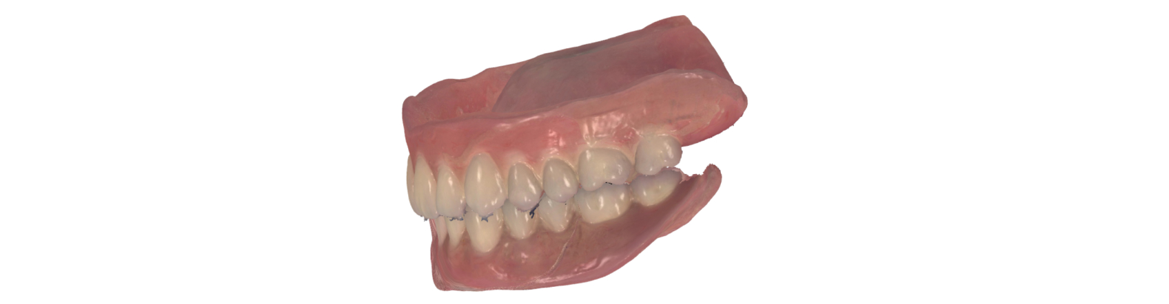 9971 Digest Reference Denture Fig 3