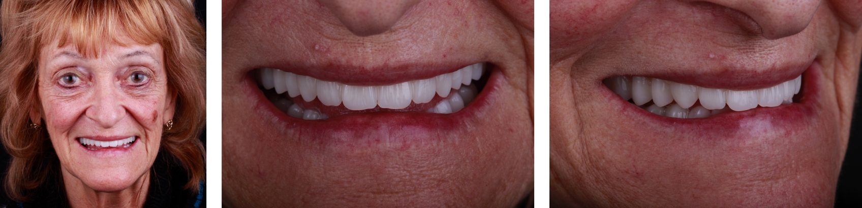 9971 Digest Reference Denture Fig 31 33