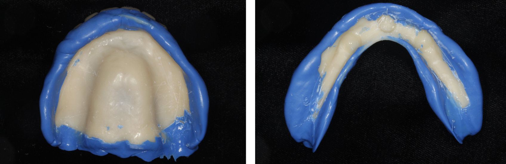 9971 Digest Reference Denture Fig 5 6
