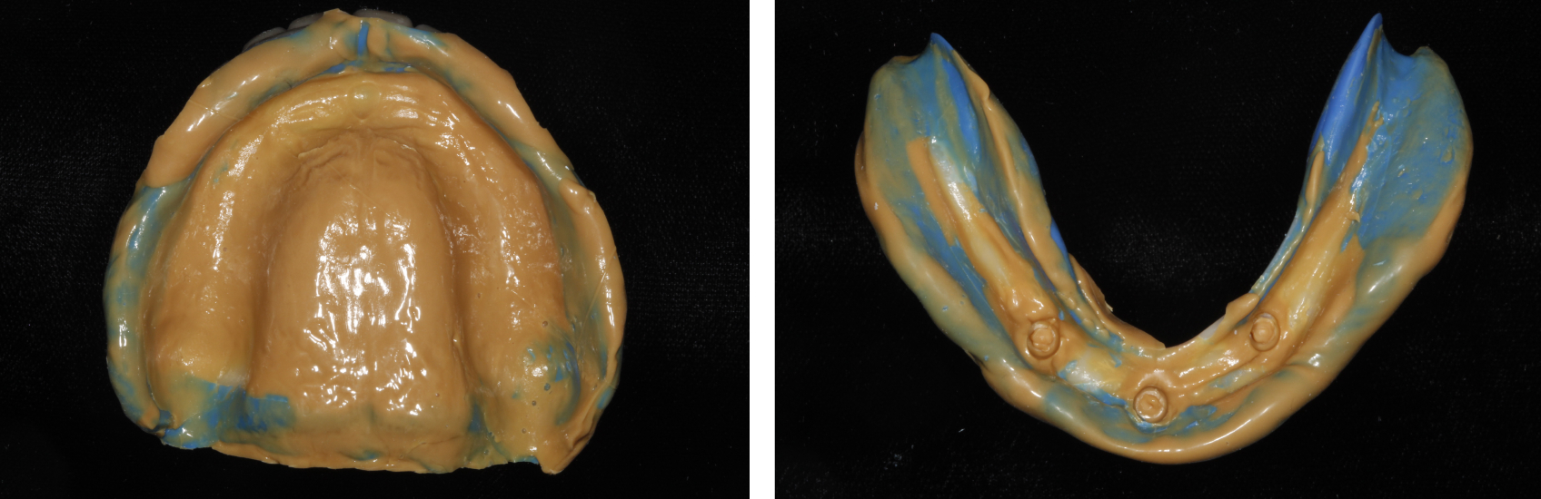 9971 Digest Reference Denture Fig 7 8