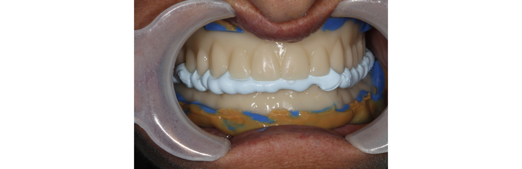 9971 Digest Reference Denture Fig 9