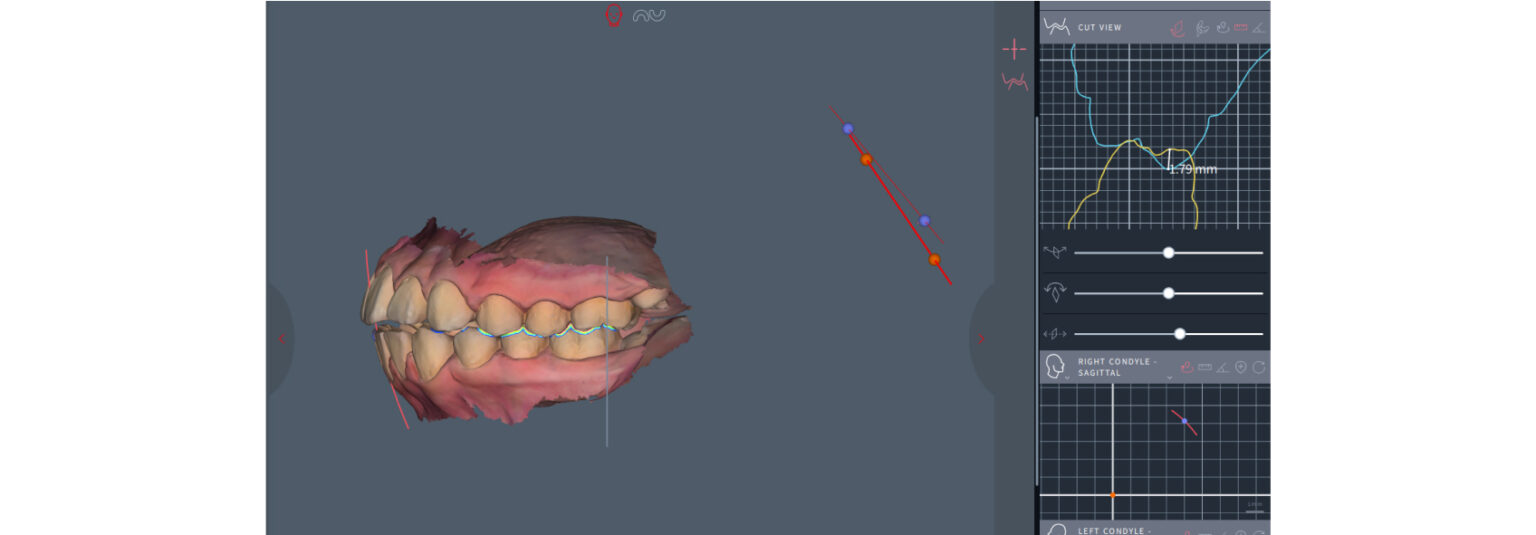 Mandibular Slides and Occlusal Management - Spear Education