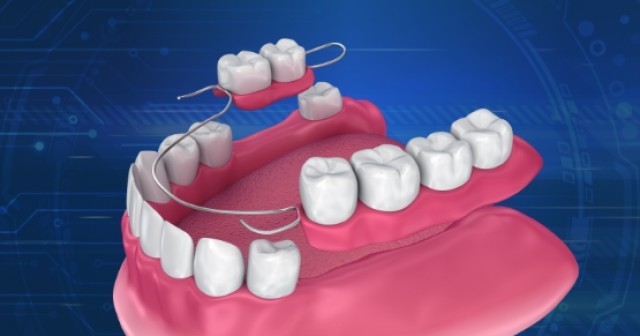Artificial Intelligence (AI) in Dentistry: RPD Design Ahmed Mahrous AI in RPD featured image