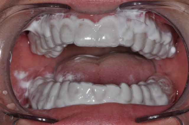 Andrew Cohen MI Paste Plus and White Spot Lesions Figure 2