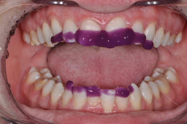 Andrew Cohen MI Paste Plus and White Spot Lesions Figure 3