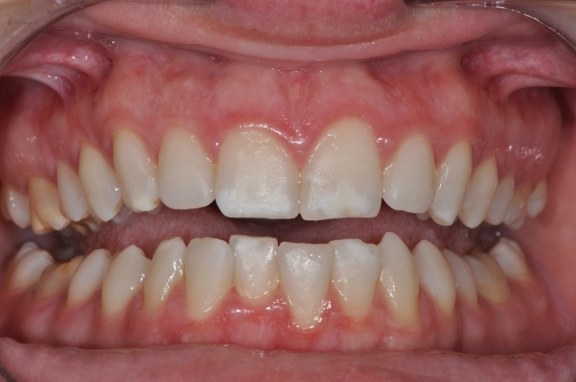 Andrew Cohen MI Paste Plus and White Spot Lesions Figure 4