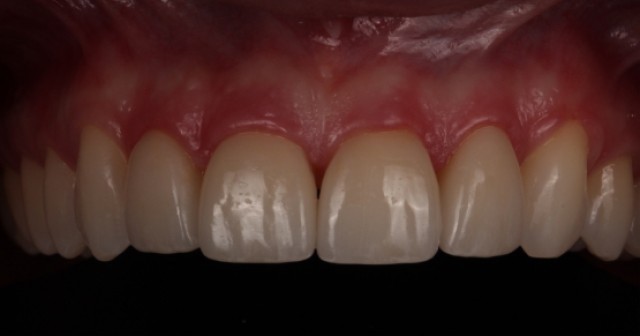 Flash Systems for Dental Photography