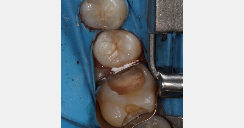 Two Restorative Uses for Teflon Tape in Dentistry Andy Janiga Teflon Tape Fig 1