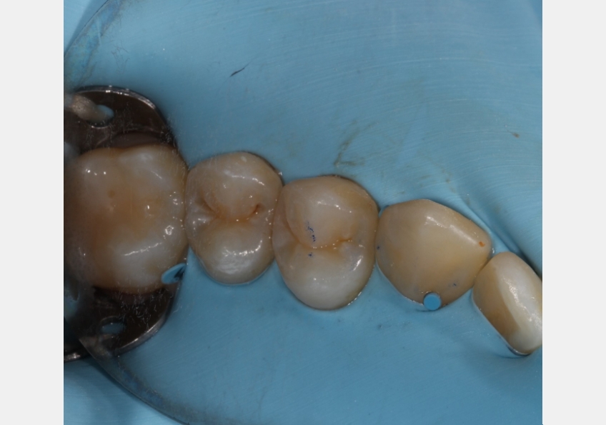 Two Restorative Uses for Teflon Tape in Dentistry Andy Janiga Teflon Tape Fig 3