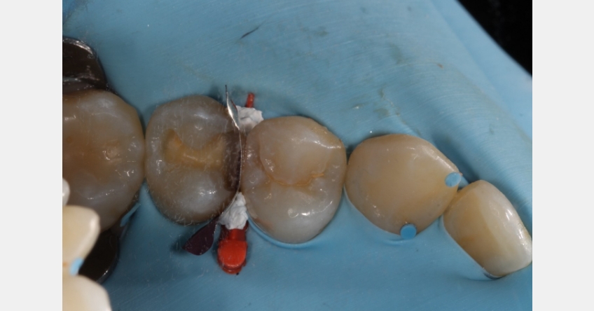 Two Restorative Uses for Teflon Tape in Dentistry Andy Janiga Teflon Tape Fig 4