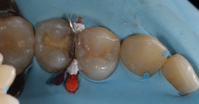 Two Restorative Uses for Teflon Tape in Dentistry