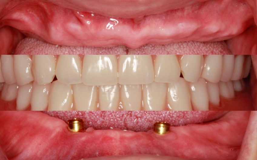 Restorative Space for Locators: How Much is Enough? Benting restorative space locaters 01