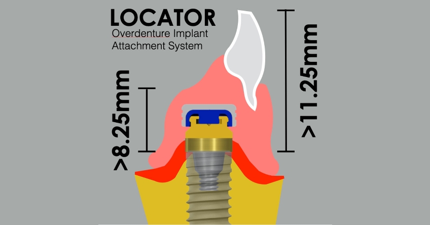 Restorative Space for Locators: How Much is Enough? Benting restorative space locaters 02