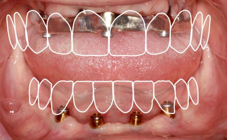 Restorative Space for Locators: How Much is Enough?