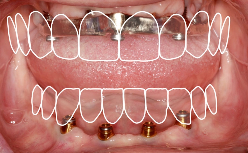 Restorative Space for Locators: How Much is Enough? Benting restorative space locaters 03