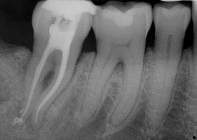 Vertical Root Fractures: The Diagnostic Dilemma and Hidden Menace Berman vertical root fractures 02