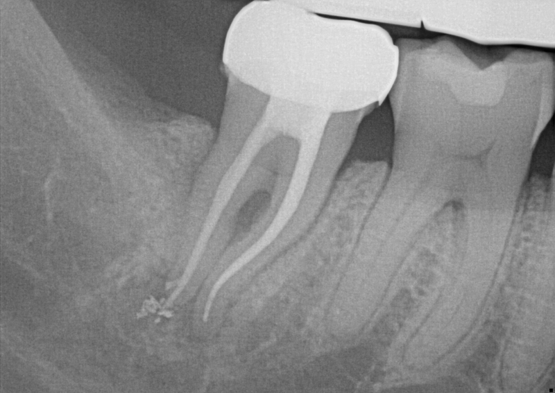 Vertical Root Fractures: The Diagnostic Dilemma and Hidden Menace Berman vertical root fractures 03 1