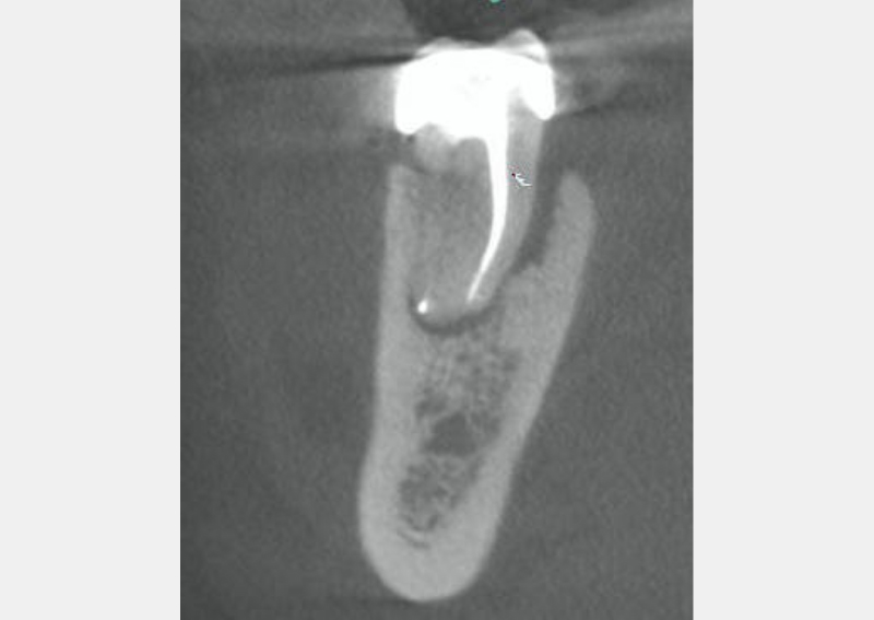 Vertical Root Fractures: The Diagnostic Dilemma and Hidden Menace Berman vertical root fractures 05