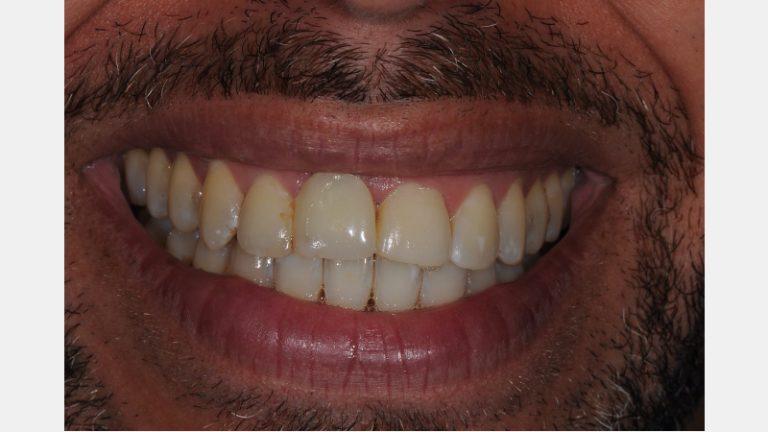 A Guide to Pre-Prep Diagnostic Mock-Ups