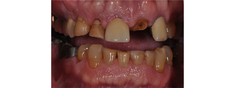 Taking the ‘Voodoo’ Out of Vertical Dimension of Occlusion Bonk taking voodoo vertical dimension 01