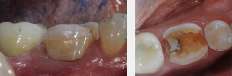 Technique for ‘Cementing’ and Retaining Conservative Ceramic Onlay Provisionals