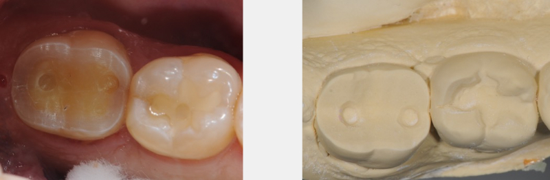 Technique for 'Cementing' and Retaining Conservative Ceramic Onlay Provisionals Bonk technique for cementing retaining 02