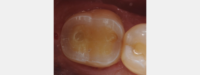 Technique for 'Cementing' and Retaining Conservative Ceramic Onlay Provisionals Bonk technique for cementing retaining 03