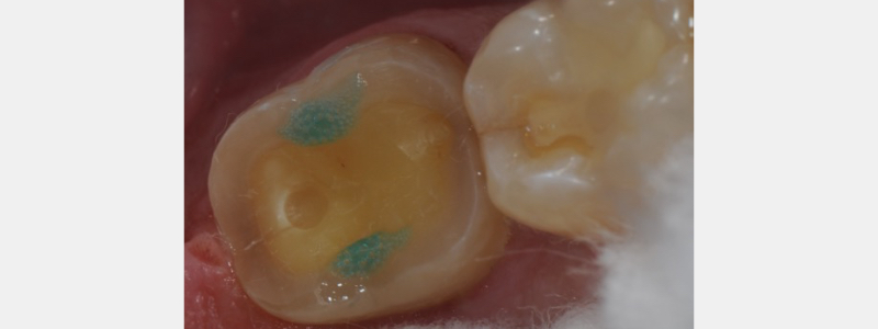 Technique for 'Cementing' and Retaining Conservative Ceramic Onlay Provisionals Bonk technique for cementing retaining 04