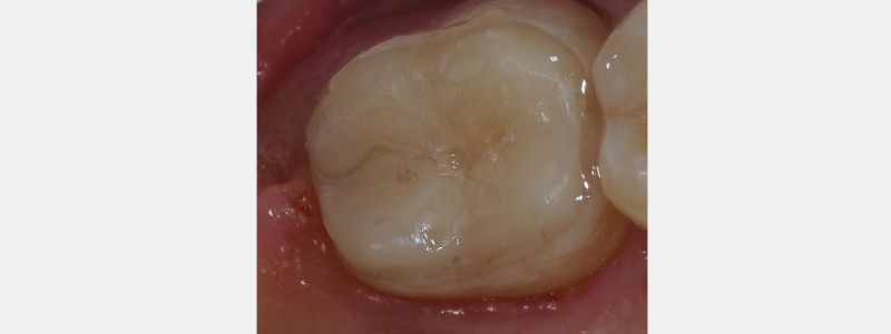 Technique for 'Cementing' and Retaining Conservative Ceramic Onlay Provisionals Bonk technique for cementing retaining 05