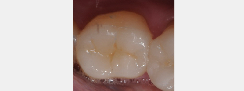 Technique for 'Cementing' and Retaining Conservative Ceramic Onlay Provisionals Bonk technique for cementing retaining 06