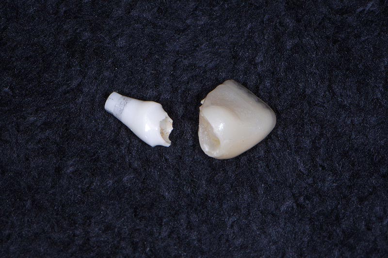 When to Use Zirconia Abutments Carson zirconia abutments 02