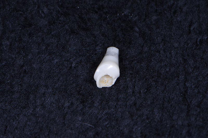 When to Use Zirconia Abutments Carson zirconia abutments 03