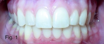 Understanding the Bolton Ratio Cheryl DeWood Understanding the Bolton Ratio Figure 1 1