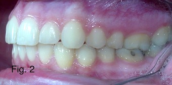 Understanding the Bolton Ratio Cheryl DeWood Understanding the Bolton Ratio Figure 2